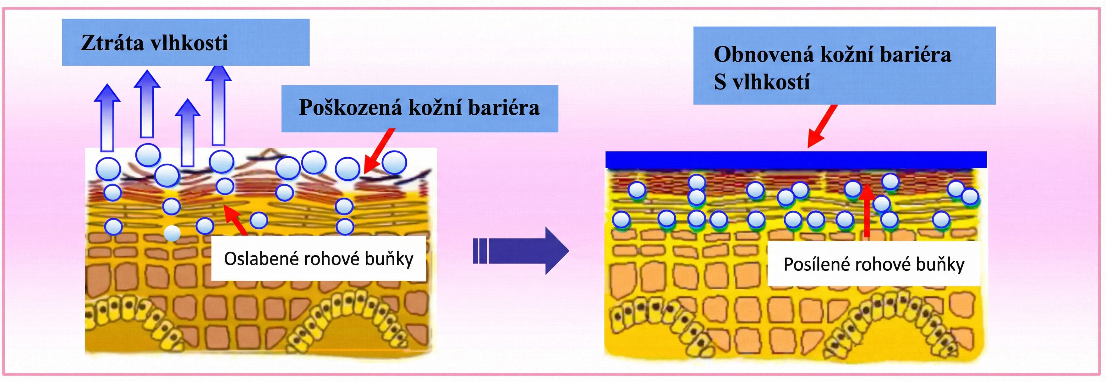 Diagram hydratace kůže - porovnání poškozené a obnovené kožní bariéry