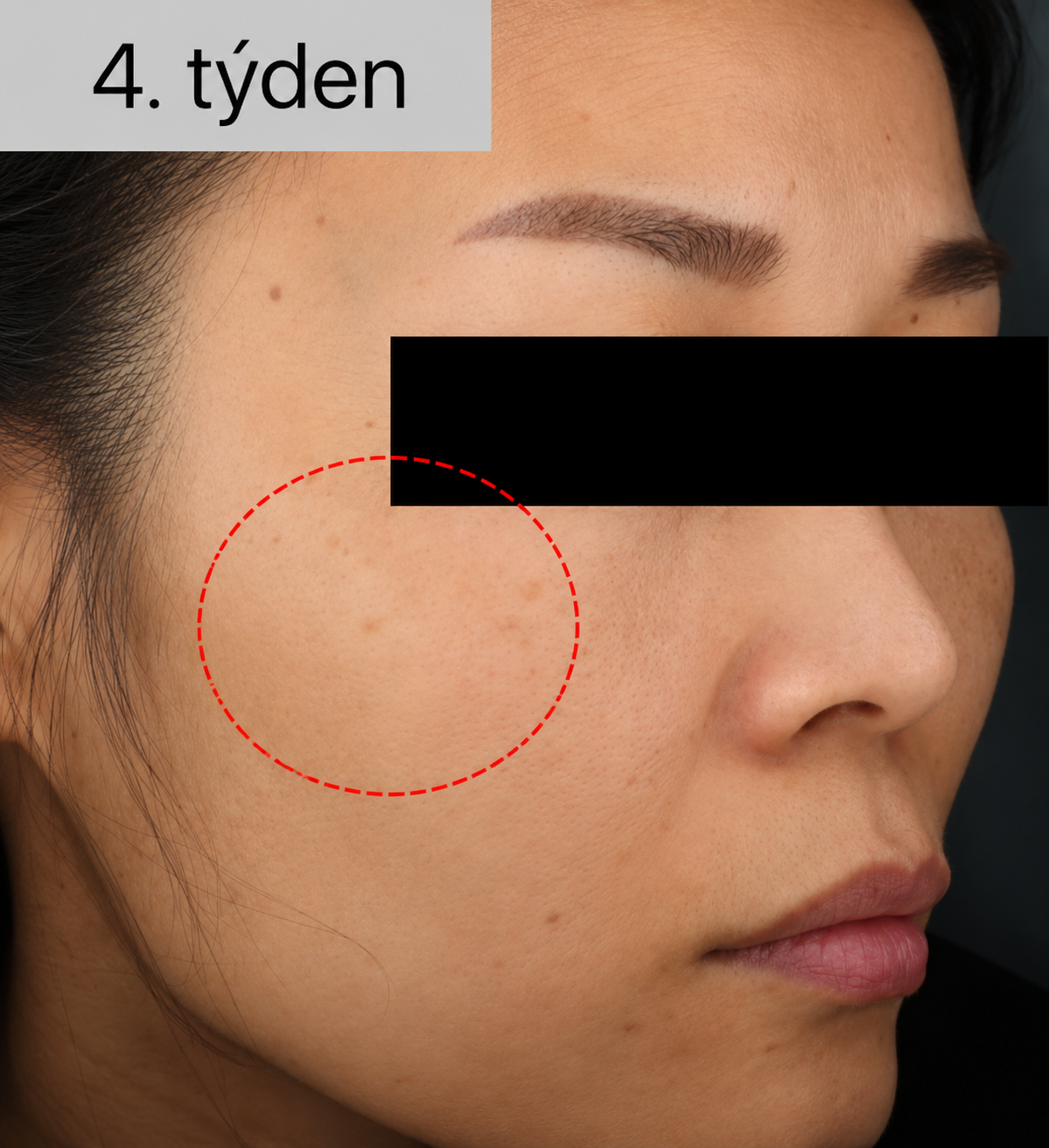 Pacient 1 – 4. týden